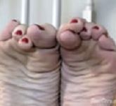 causes of hot feet bare leg thumbs
